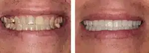 No-prep veneers close-up results Summerlin cosmetic dentist”
