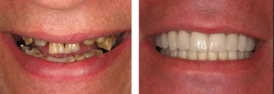 Top rated Summerlin dentist before after patient results”