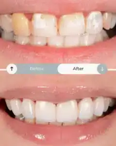 Veneer replacement corrective case Las Vegas cosmetic dentist”
