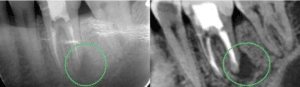 3D CBCT imaging detecting hidden tooth abscess vs standard X-ray Summerlin Dental Solutions best dentist Summerlin Las Vegas