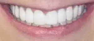 after veneers results at summerlin dental solutions