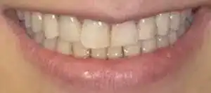 before veneers at summerlin dental solutions