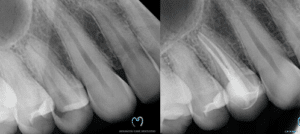 "Delayed dental emergency cavity to root canal cost comparison Las Vegas dentist"