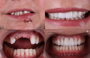"Emergency broken tooth dental implant restoration Las Vegas Summerlin before after"