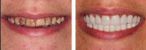 Full dental restoration insurance and financing combined before and after Summerlin Dental Solutions best dentist Las Vegas Nevada