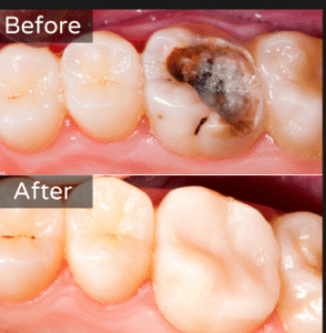 Conservative composite filling instead of unnecessary crown honest dentist Summerlin Dental Solutions Las Vegas