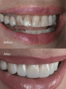 Smile makeover insurance and CareCredit financing before and after Summerlin Dental Solutions Las Vegas cosmetic dentist