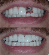 "Emergency broken tooth repaired same-day crown Las Vegas Summerlin dentist before after"