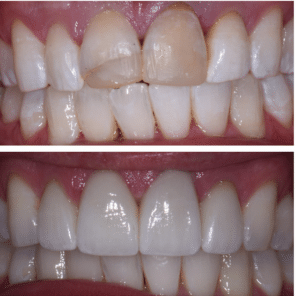 Insurance covered porcelain crown before and after Summerlin Dental Solutions dentist Las Vegas Nevada