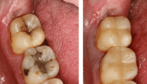 AI-detected early tooth decay treated with filling covered by dental insurance Summerlin Dental Solutions Las Vegas