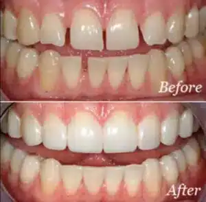 before and after dental veneers at summerlin dental solutions