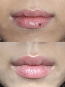 Lip pigmentation resolution