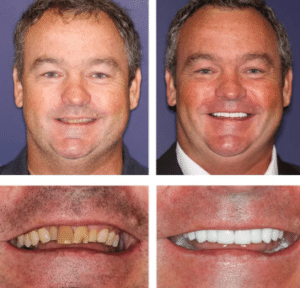 'Before and after dental veneers results at Summerlin Dental Solutions in Las Vegas.'