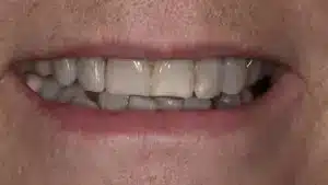 Smile makeover before at Summerlin Dental Solutions in Las Vegas