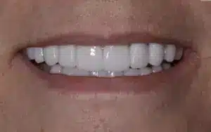 Smile makeover results at Summerlin Dental Solutions in Las Vegas