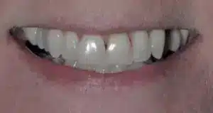 Smile makeover before at Summerlin Dental Solutions in Las Vegas