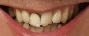 Smile makeover before at Summerlin Dental Solutions in Las Vegas