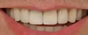 Smile makeover results at Summerlin Dental Solutions in Las Vegas