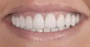 Smile makeover results at Summerlin Dental Solutions in Las Vegas