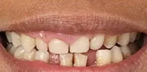 Smile makeover before at Summerlin Dental Solutions in Las Vegas
