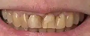 Smile makeover before at Summerlin Dental Solutions in Las Vegas