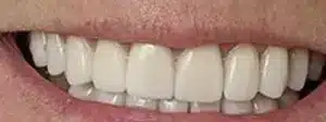Smilemakeover after