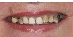 Smile makeover before at Summerlin Dental Solutions in Las Vegas