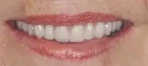Smile makeover results at Summerlin Dental Solutions in Las Vegas
