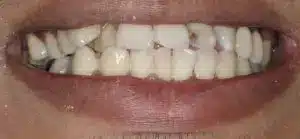 Smile makeover before at Summerlin Dental Solutions in Las Vegas