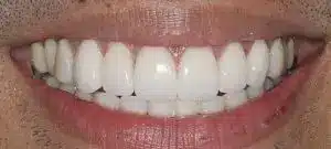 Smile makeover results at Summerlin Dental Solutions in Las Vegas