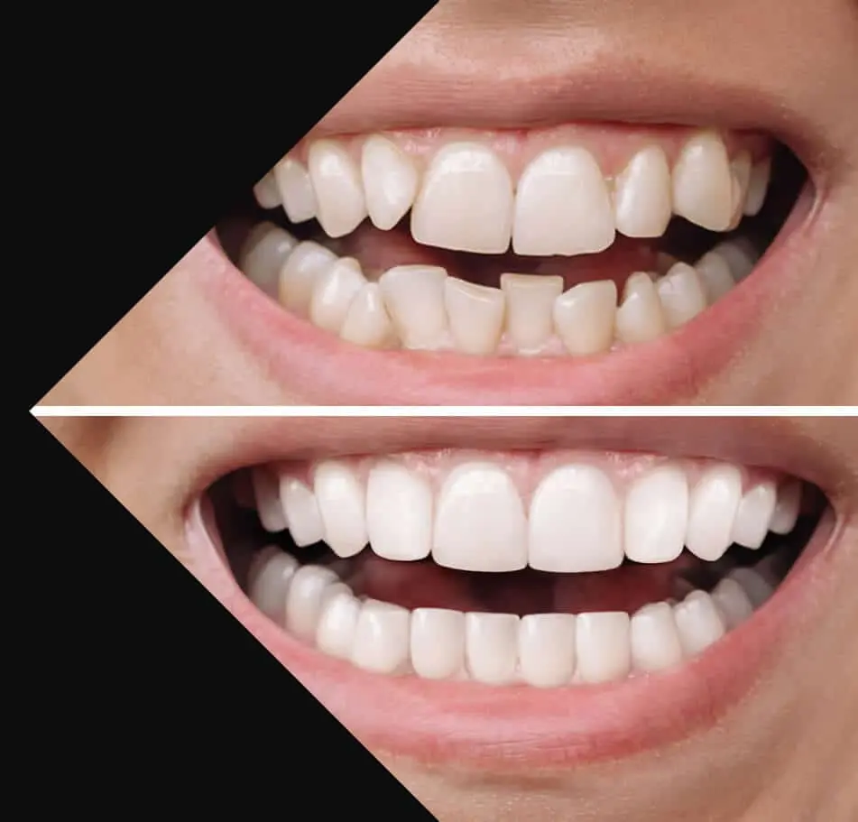 before and after invisalign at summerlin dental solutions