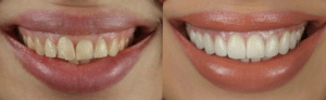 A Summerlin Smile Makeover