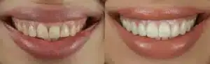 A Summerlin Smile Makeover