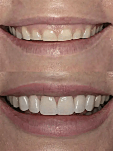 SM Gummy smile Summerlin Dental Solutions