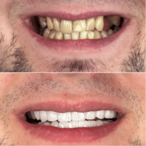 Smile Makeover Summerlin Dental Solutions