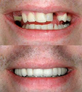 tooth replacement at Summerlin Dental Solutions