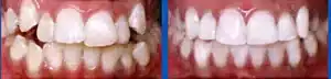 sm apge Invisalign at Summerlin Dental Solutions